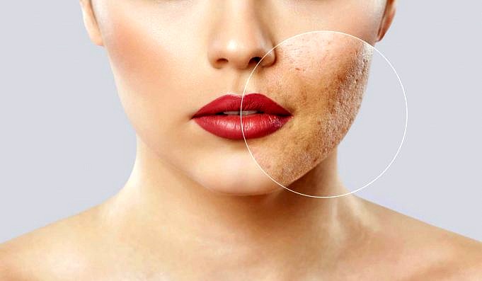 La Tretinoina Va Bene Per L'acne Da Lieve A Moderata?