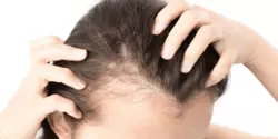Perdita di capelli e alopecia
